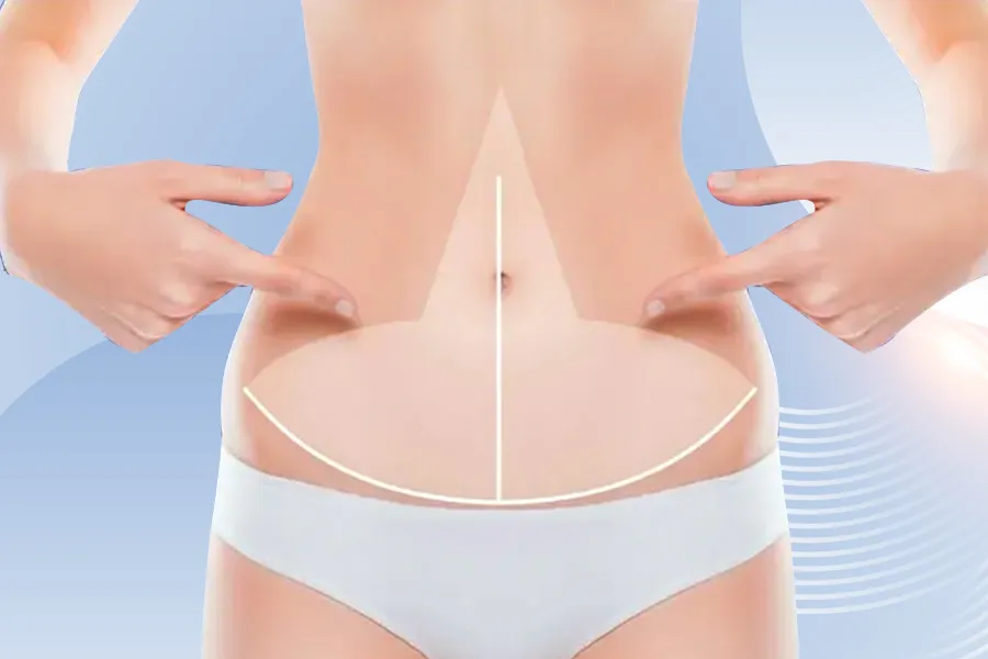 FDL-Bauchdeckenstraffung