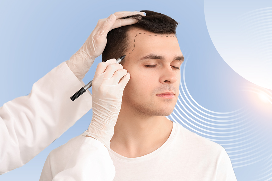 FUE Method (Follicular Unit Extraction)