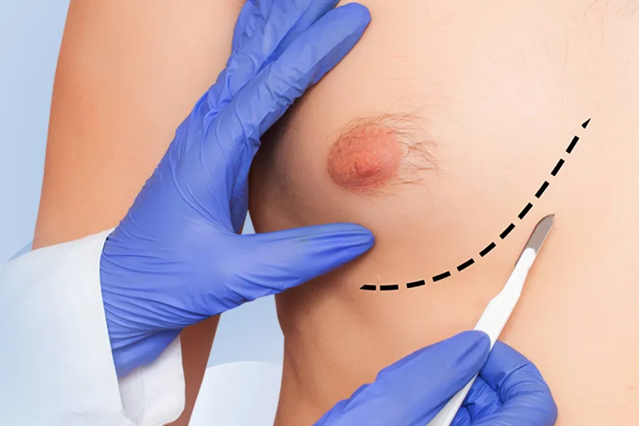 Gynäkomastie (Männerbrustkorrektur)